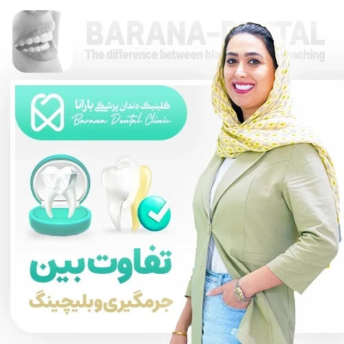 تفاوت بلیچینگ و جرم‌ گیری دندان