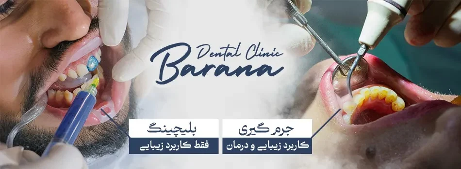 تفاوت بلیچینگ و جرم‌ گیری دندان