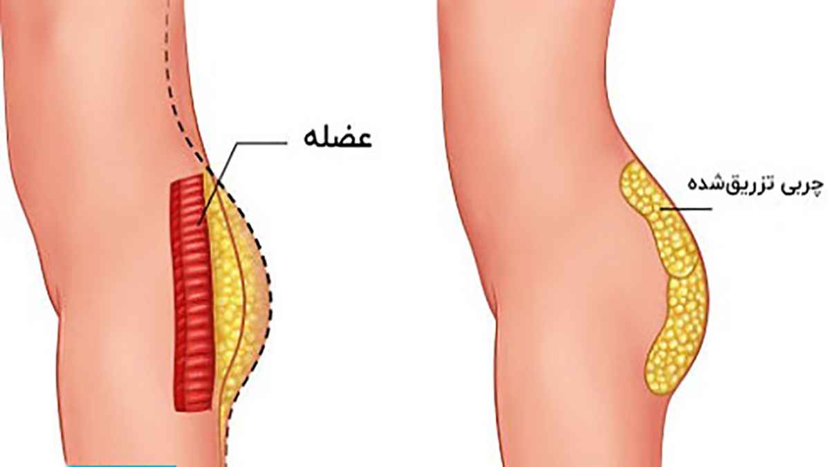 تزریق چربی بهتر است یا تزریق ژل؟